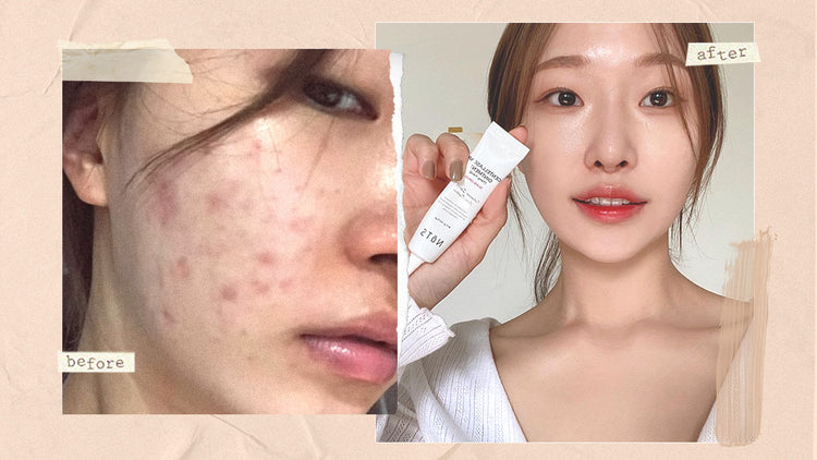 Skin Care for Acne/Texture