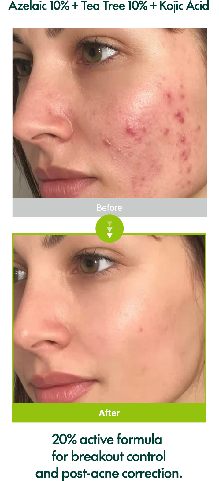 Azelaic Acid 10 Tea Tree Serum by Purito